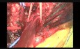 Kaniulacja tętnicy pachowej