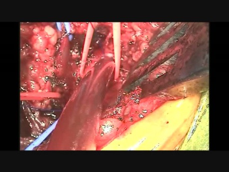 Kaniulacja tętnicy pachowej