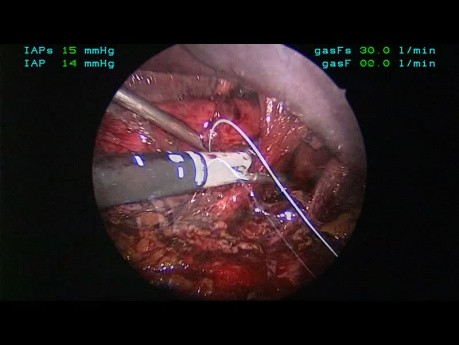 Operacja przepukliny okołoprzełykowej metodą laparoskopową z użyciem siatki przepuklinowej