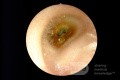 Przewlekłe zapalenie ucha zewnętrznego kilkoma patogenami