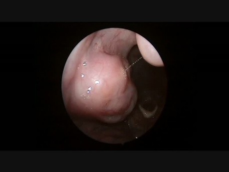 Diagnostyczna endoskopia jamy ustnej i krtani