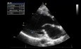 Echokardiograficzna zagadka - jak ciężka jest niedomykalność zastawki aortalnej?