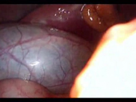 Perforacja okrężnicy z zapaleniem otrzewnej - laparoskopia (41 z 46)
