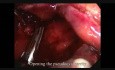 Laparoskopowe usunięcie pozapalnej pseudotorbieli trzustki