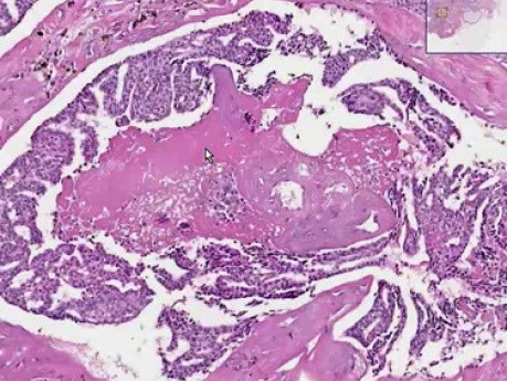 Rak przewodowy in situ - histopatologia - pierś