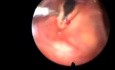 Laryngoskopia z biopsją struny głosowej