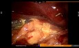 Robotic Assisted Right Adrenalectomy with IVC Thrombectomy