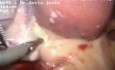 Rękawowa resekcja żołądka z cholecystektomią i założeniem siatki przepuklinowej