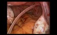 SELS - założenie szwu szyjkowego z dojścia przezbrzusznego metodą laparoskopową (LTAC)