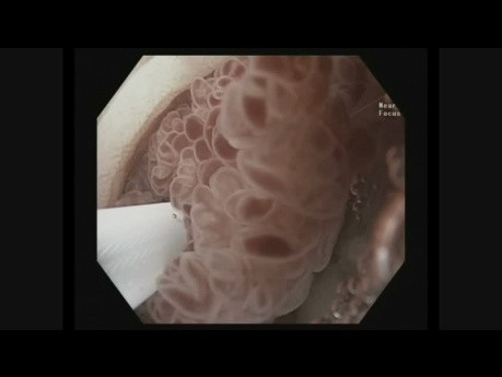 Endoskopowa resekcja śluzówki jelita grubego pod wodą