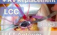 TCRAT-CABG + AVR przez lewostronną przednią torakotomię