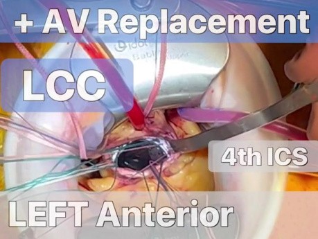 TCRAT-CABG + AVR przez lewostronną przednią torakotomię