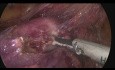 Całkowita histerektomia laparoskopowa z limfadenektomią