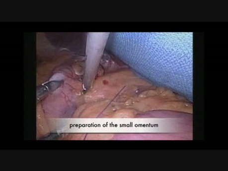 Gastric bypass - operacja bariatryczna - przypadek pacjenta z odwrotnym ułożeniem trzewi