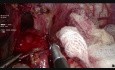 Laparoskopowa kardiomiotomia sposobem Hallera z powodu achalazji przełyku