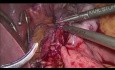Od laparoskopowej plikacji żołądka do wyłączenia żołądkowego z zespoleniem na pętli Roux-en-Y