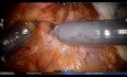 Robotyczna dystalna pankreatektomia z oszczędzeniem śledziony w leczeniu litego guza rzekomobrodbawkowatego trzustki (SPN)