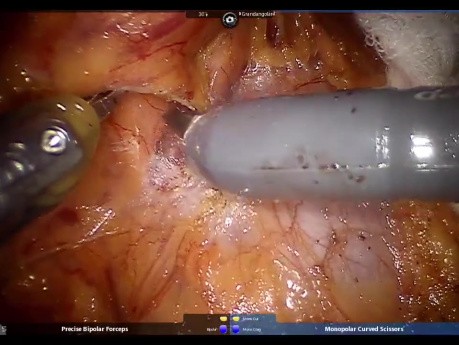 Robotyczna dystalna pankreatektomia z oszczędzeniem śledziony w leczeniu litego guza rzekomobrodbawkowatego trzustki (SPN)