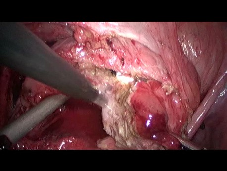 Laparoskopowa resekcja endometriozy wrastającej w pęcherz moczowy 