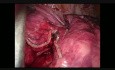 Wideotorakoskopowa prawa dolna lobektomia z jednego cięcia bez asysty
