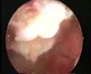 Leczenie histeroskopowe mięśniaka macicy
