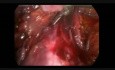 Radykalna laparoskopowa histerektomia z limfadenektomią w raku szyjki macicy