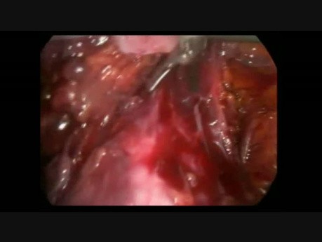 Radykalna laparoskopowa histerektomia z limfadenektomią w raku szyjki macicy