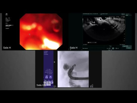 Przezjelitowe ECPW pod kontrolą EUS (Endoscopic Ultrasound-Directed Transenteric ERCP- EDEE)