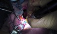 Przeszczep Kostny - przeszczep bloku kostnego z gałęzi Ustabilizowanie i Zamknięcie
