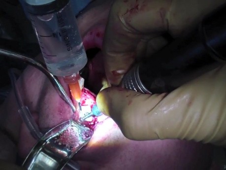 Przeszczep Kostny - przeszczep bloku kostnego z gałęzi Ustabilizowanie i Zamknięcie
