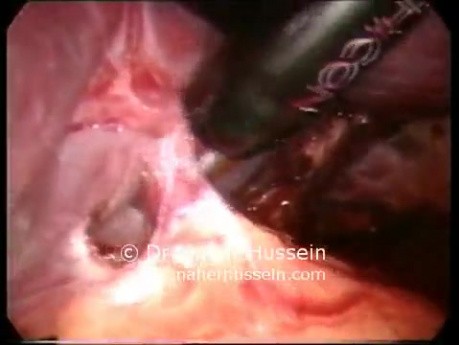 Splenektomia laparoskopowa