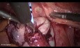 Laparoskopowa reimplantacja moczowodu z powodu zwężenia w przebiegu endometriozy 