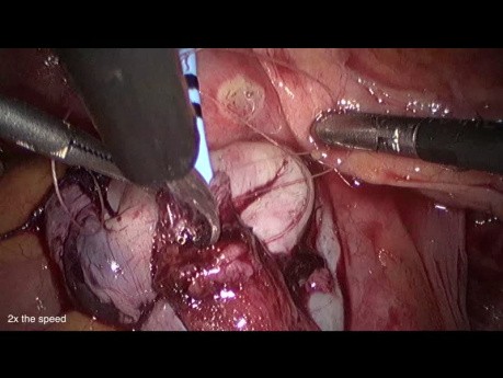 Laparoskopowa reimplantacja moczowodu z powodu zwężenia w przebiegu endometriozy 