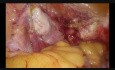 Histerektomia- pacjentka po dwóch cesarskich cięciach