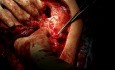 Włókniakomięsak (fibrosarcoma) ściany klatki piersiowej