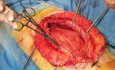 Laparotomia - sekwencyjne chirurgiczne zamknięcie