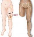 Amputacja powyżej kolana