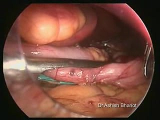 Leczenie chirurgiczne otyłości- gastrektomia laparoskopowa