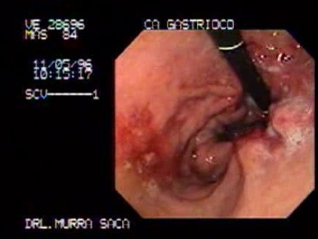 Gruczolakorak dna żołądka - pacjent ze znacznym spadkiem masy ciała