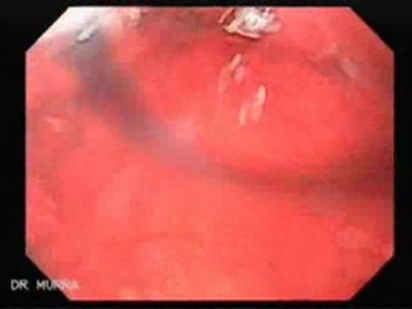 Rak włóknisty żołądka - endoskopia (17 z 47)