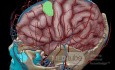 Estirpación de cavernoma subcortical 