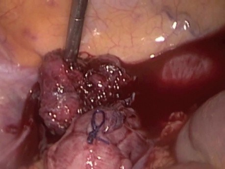 Perforacja odbytnicy - szycie laparoskopowe