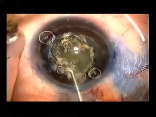 Kapsulotomia w małym oku przy użyciu ostrza Fugo