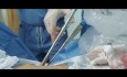 Wideotorakoskopowa lobektomia środkowa z jednego cięcia bez asysty