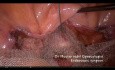 Pektopeksja przy wypadaniu narządów układu moczowo-płciowego