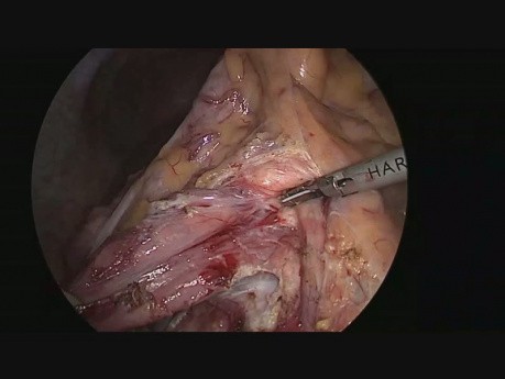 Laparoskopowa duodenojejunostomia z powodu zespołu tętnicy krezkowej górnej