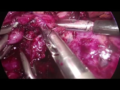 Laparoskopowa dystalna pankreatektomia z powodu śluzowego nowotworu torbielowatego (MCN) z oszczędzeniem śledziony
