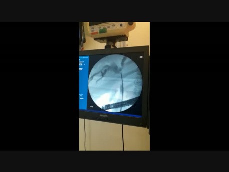 Biopsja kleszczykowa guza Klatskina pod kontrolą fluoroskopii
