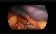 Splenektomia laparoskopowa u dziecka z zastosowaniem techniki "vessels first"