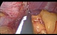 Rękawowa resekcja żołądka - Sleeve Gastrectomy